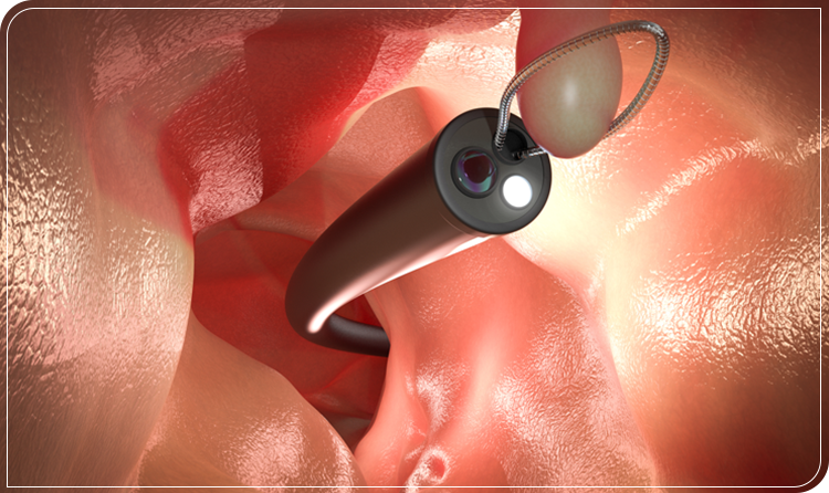 大腸ポリープ切除の日帰り手術に対応